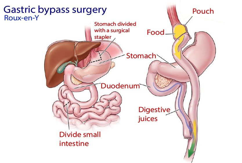 gastric_by_pass_in_turkey_procedure