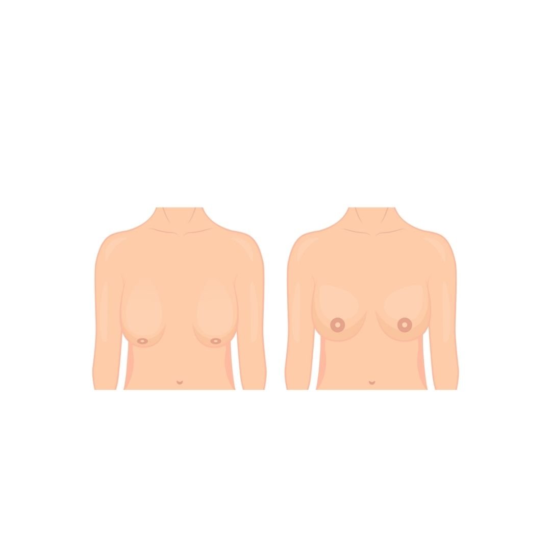 gogus-kaldirma-ameliyati