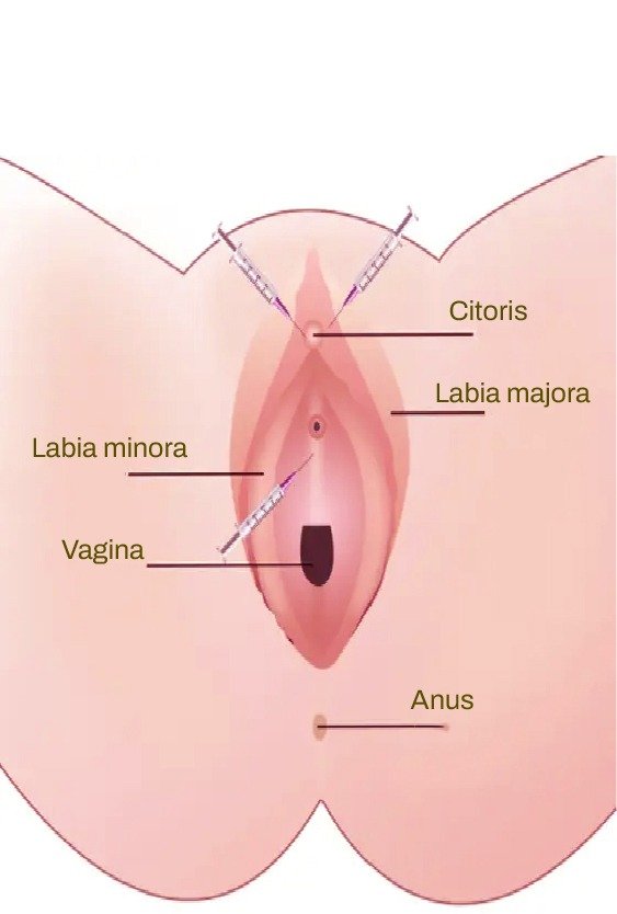 gspot_amplification_for_cosmetic_gynecology_in_turkey