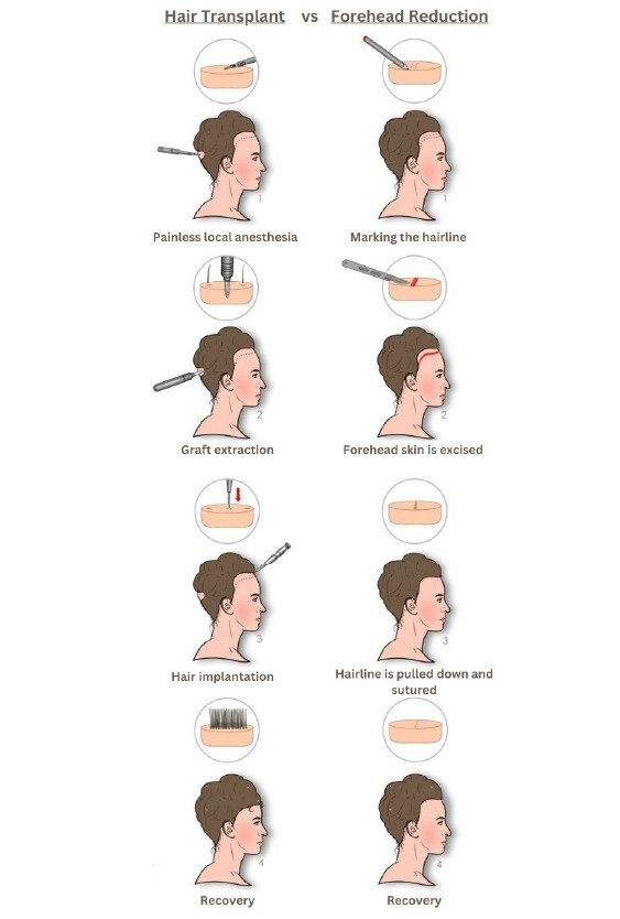 hair_transplant_vs_forhead_reduction_in_turkey