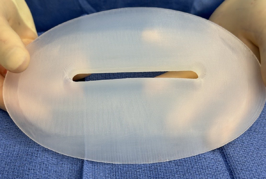hip_dip_correction_in_turkey_with_implant