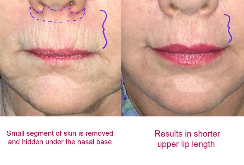 how_lip_lift_in_turkey_works