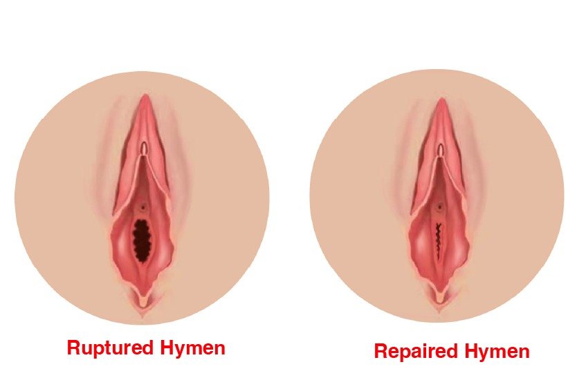 hymenoplasty_for_cosmetic_gynecoplasty_in_turkey