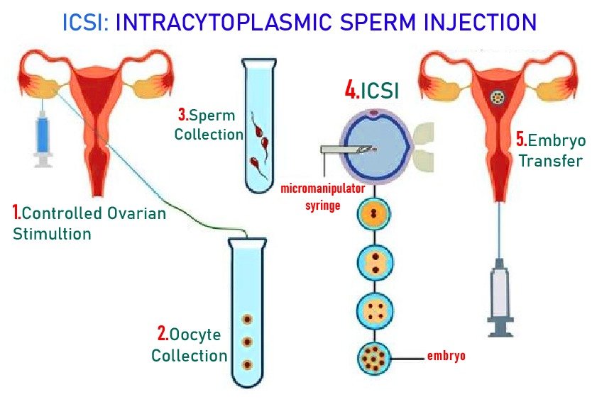 icsi_in_turkey_procedure