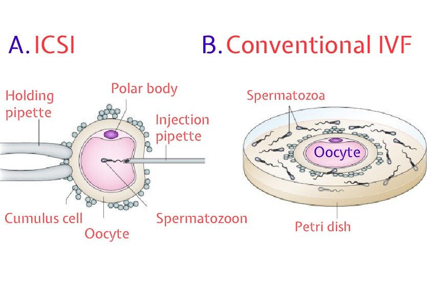 icsi_in_turkey_vs_ivf