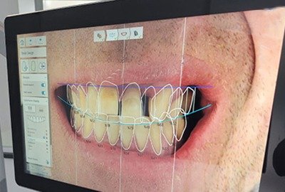 image_of_DSD_for_hollywood_smile_in_turkey