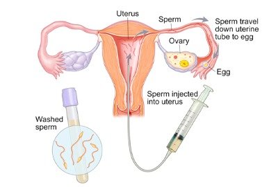 iui_in_turkey_definition