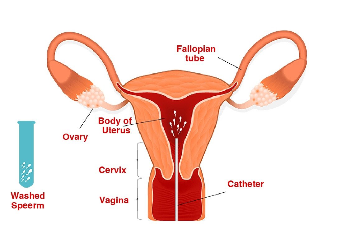 iui_in_turkey_illustration