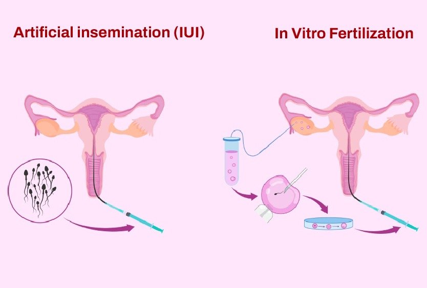 iui_vs_ivf_in_turkey