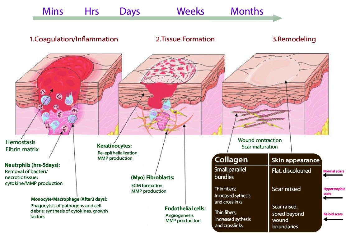 keloid_formation_process_for_keloid_treatment_in_turkey