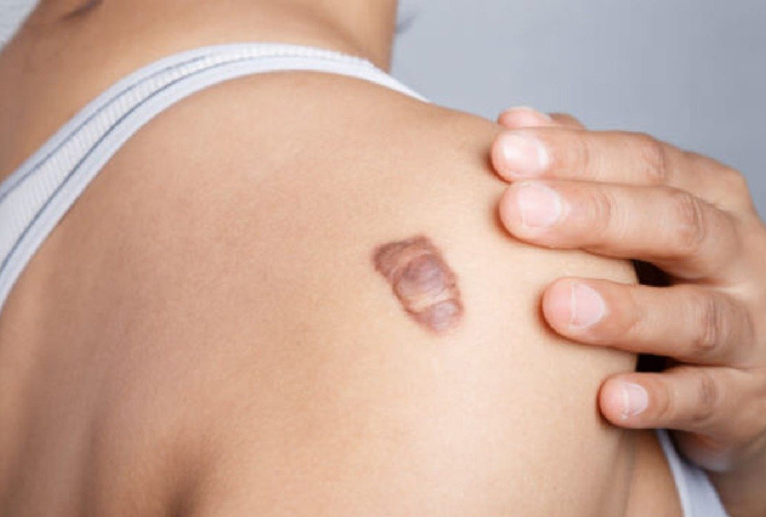 keloid_on_shoulder_before_keloid_treatment_in_Turkey