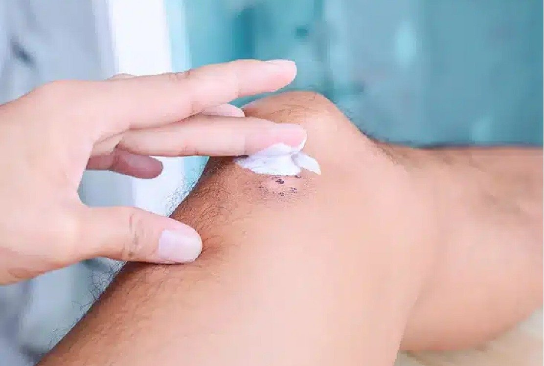 keloid_treatment_in_turkey_cream