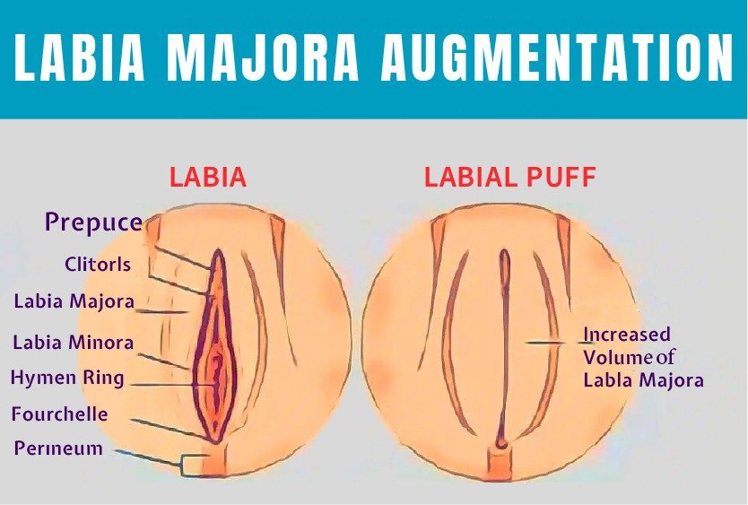 labia_majora_augmentation_for_cosmetic_gynecology_in_turkey