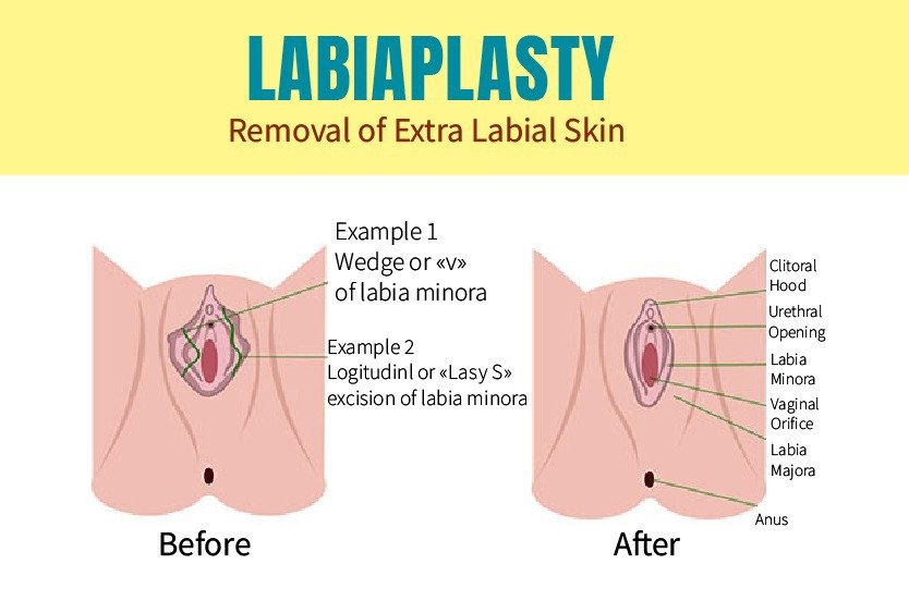 labiaplasty_for_cosmetic_gynecoplasty_in_turkey (2)
