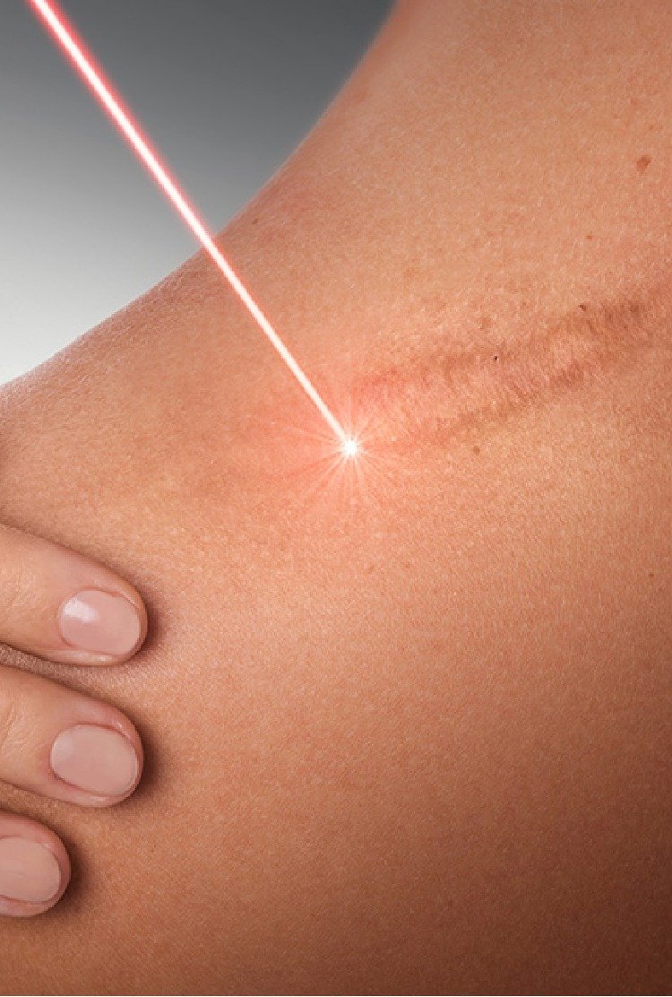 laser_therapy_keloid_treatment_in_turkey