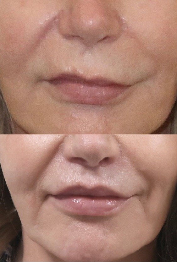 lip_lift_in_turkey_for_loop_sided_smile