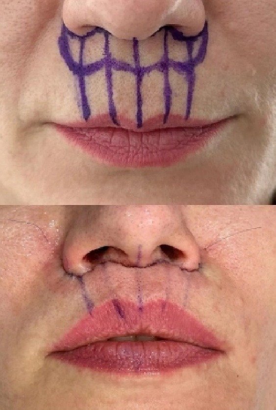 lip_lift_in_turkey_procedure