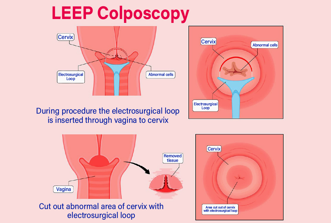 Loop-Electrosurgical-Excision-Procedure-for-Cervical-Biopsy-in-Turkey-procedure