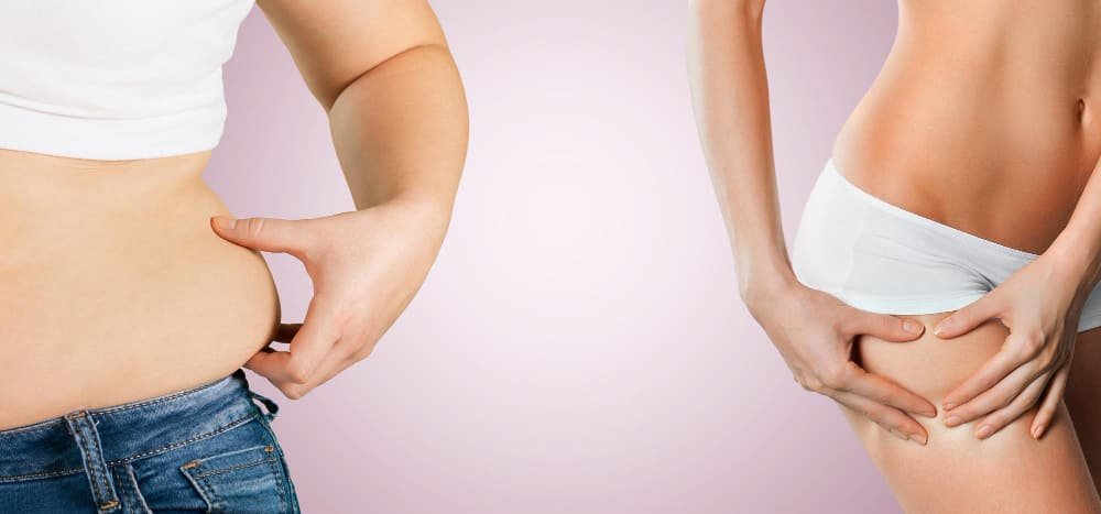 love_handles_before_and_after_liposuction_in_turkey