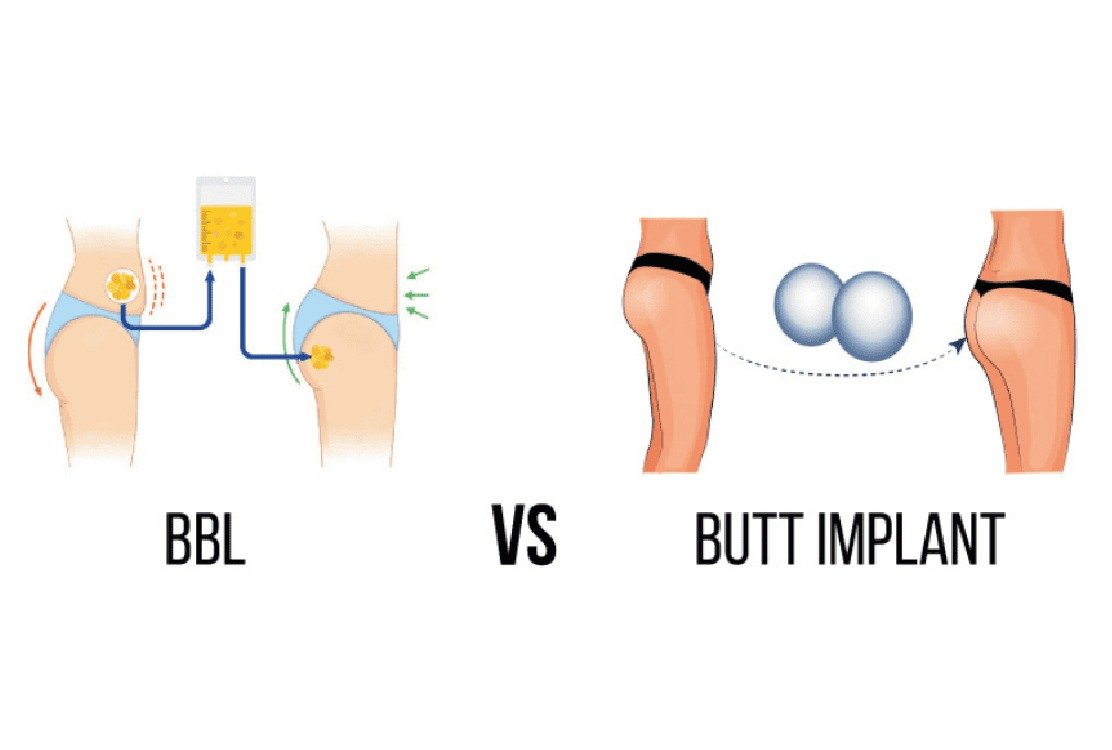 male_bbl_in_turkey_vs_implants