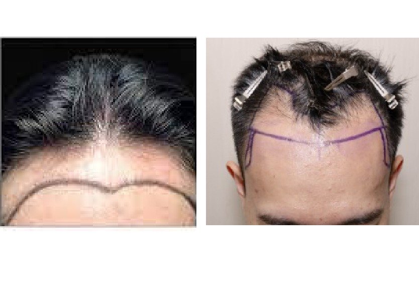male_vs_female_forehead_reduction_in_turkey