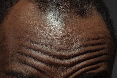 man_facing_hairloss_before_afro_hair_transplant_in_turkey
