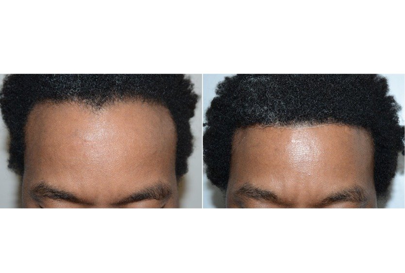 man_months_after_forehead_reduction_in_turkey