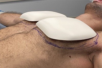 man_on_pectoral_implant_in_turkey_surgery_bed