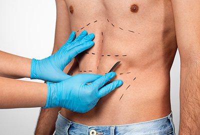 man_with_abs_surgery_in_turkey_outline