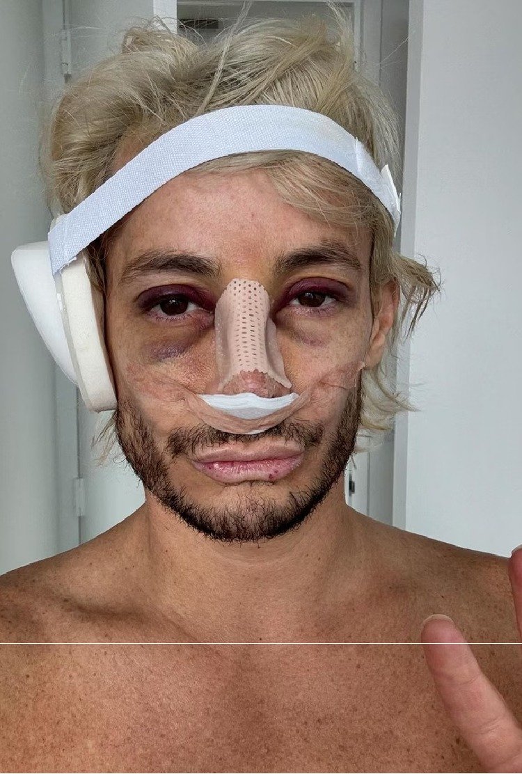 man_with_cosmetic_procedures_after_zoom_dysmorphia