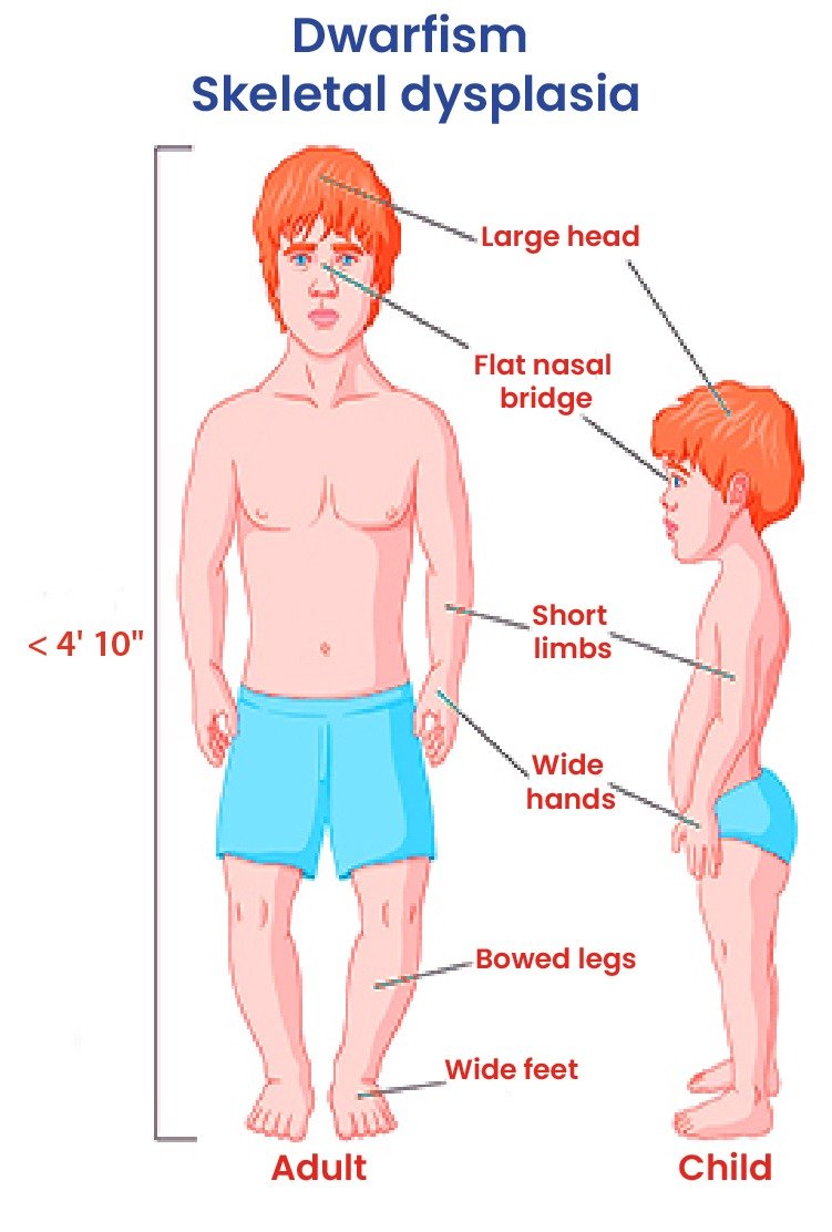 man_with_dwarfism