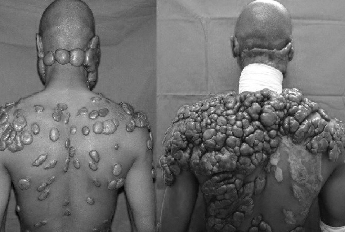 man_with_growing_keloids_for_keloid_treatment_in_turkey