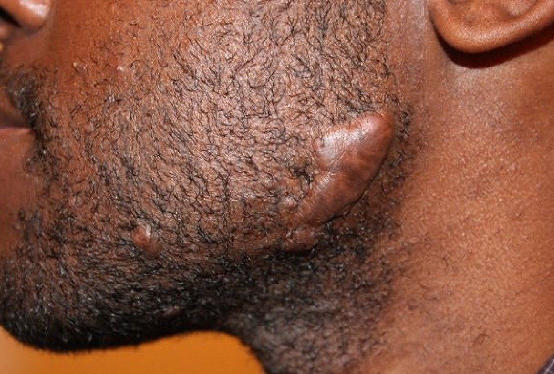 man_with_keloid_on_beard_for_keloid_treatment_in_turkey