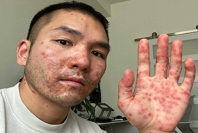 man_with_monkeypox_in_turkey