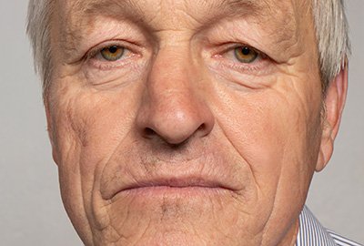 man_with_saggy_eyes_needing_blepharoplasty_in_turkey