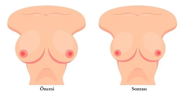 meme_kucultme_oncesi_sonrasi_cevre_hastanesi