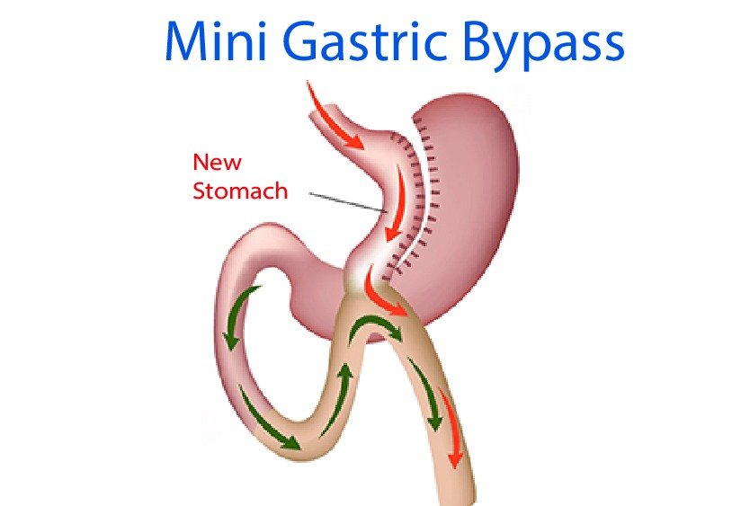 mini_gastric_by_pass_in_turkey_vector (2)