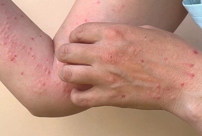 monkey_pox_in_turkey_patient