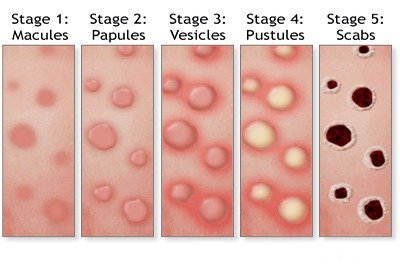 monkeypox_in_turkey_development_stages
