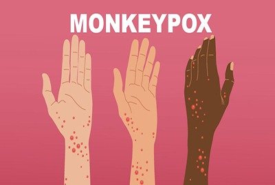 monkeypox_in_turkey_handsraising_awareness