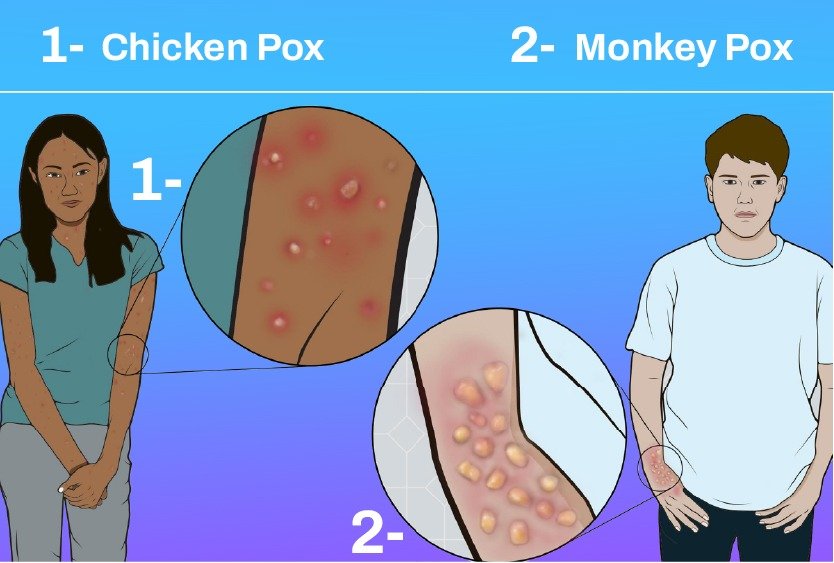 monkeypox_in_turkey_vs_chickenpox