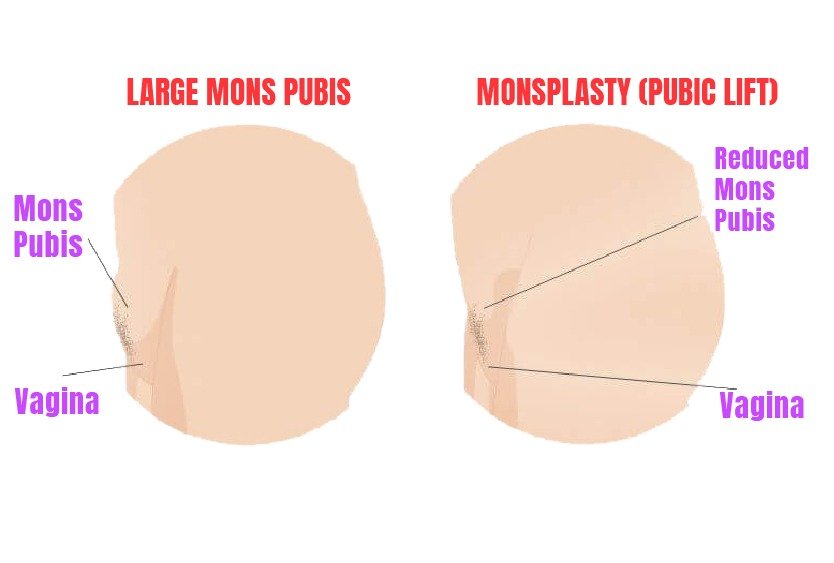 monsplasty_for_cosmetic_gynecology_in_turkey