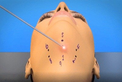 myellevate_neck_lift_in_turkey_contour_lines