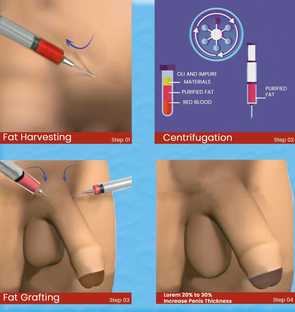 non_surgical_penis_enlargement_in_turkey_options