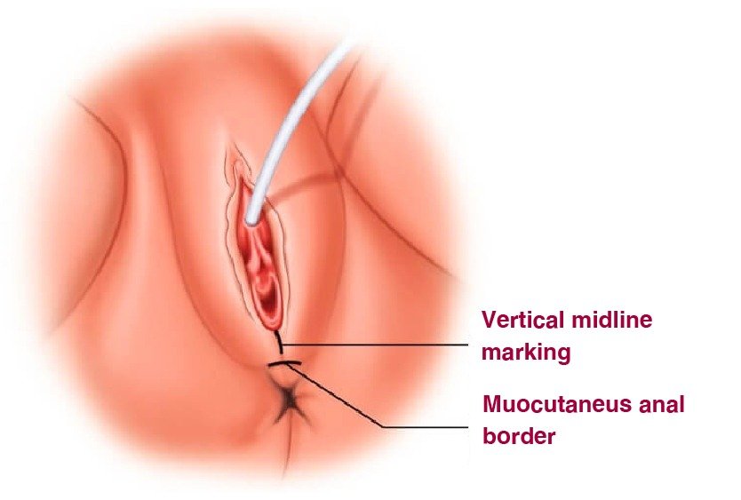 perineoplasty_for_cosmetic_gynecoplasty_in_turkey
