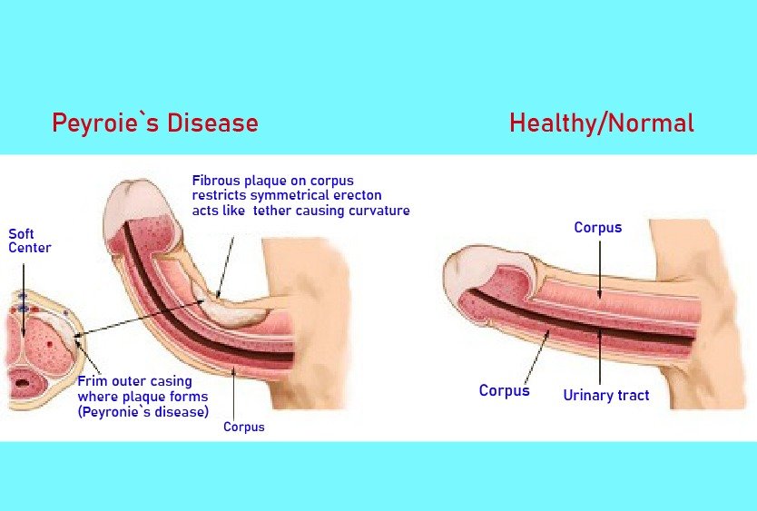 peyronies_disease_for_erectile_dysfunction_in_turkey