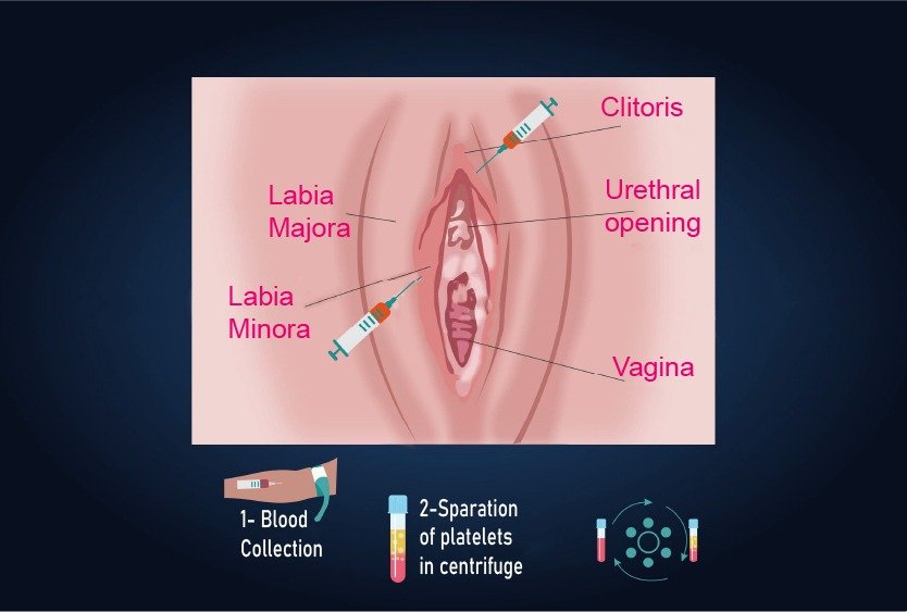 platelet_rich_fibrin_therapy_for_cosmetic_gynecology_in_turkey