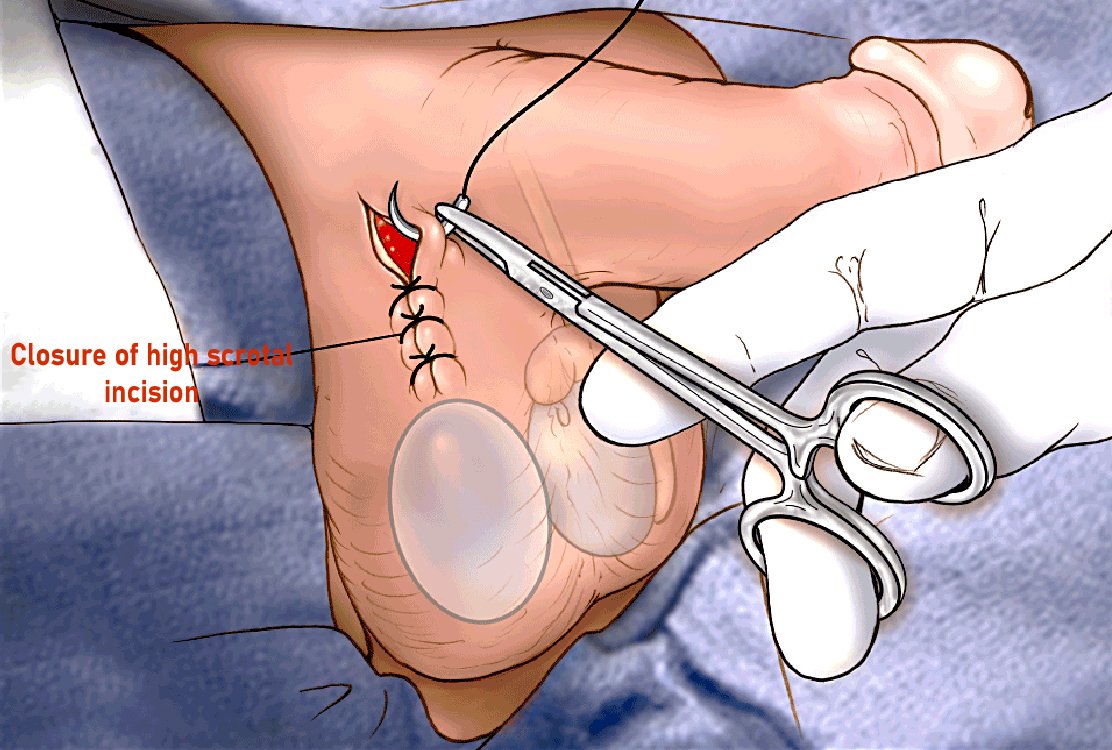 procedure-for-Testicular-Prosthesis-in-turkey