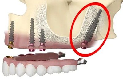 pterygoid_dental_implant_in_turkey_position_illustration (2)