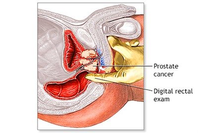 rectal_exam_for_prostatectomy_diagnosis_in_turkey